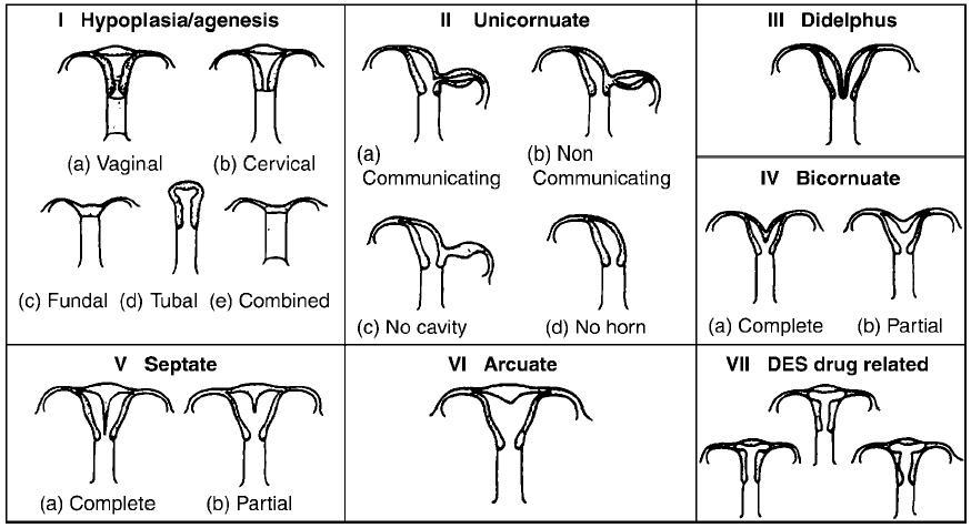anomalias uterinas