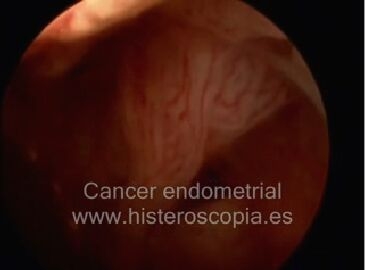 cancer endometrial video